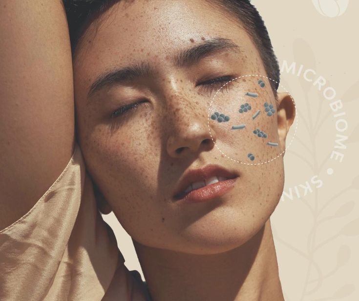 The Gut-Skin Connection: Can Your Gut Help You Get Rid of Acne?